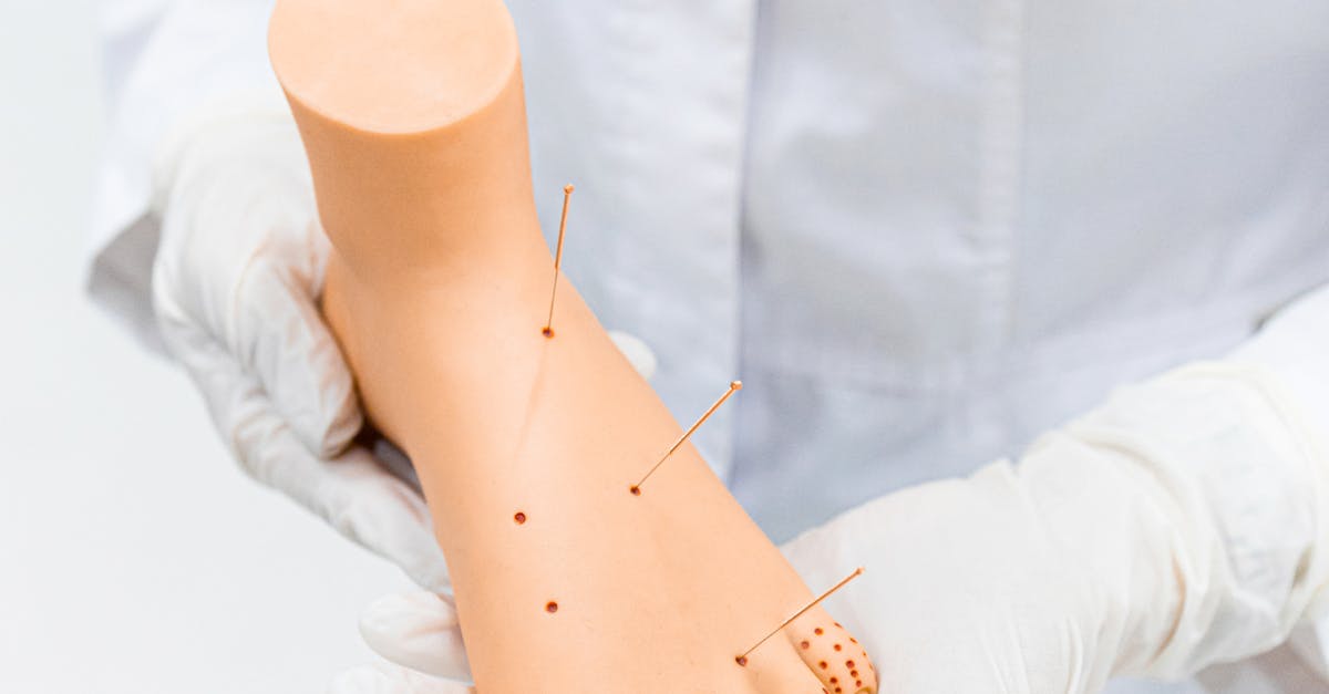 The Role of Acupuncture in Alleviating Anxiety Symptoms